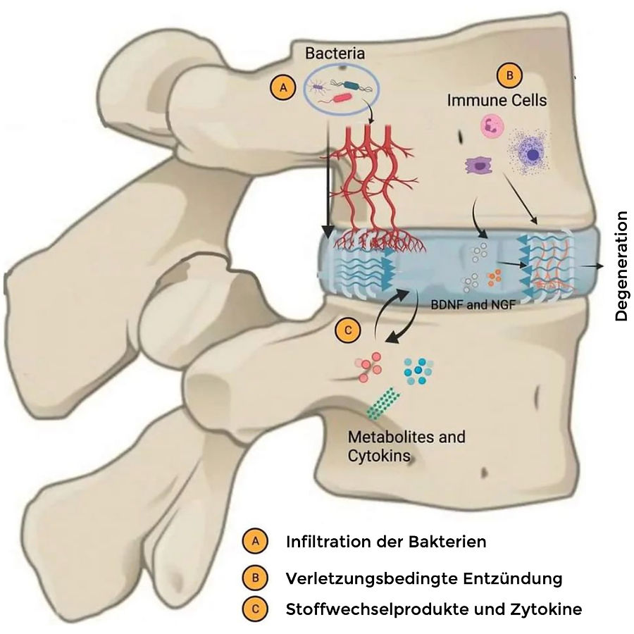 Darmflora und Bandscheibengesundheit