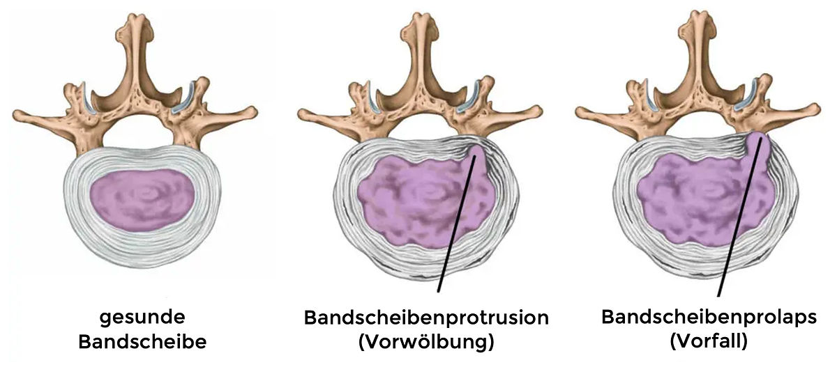 Bandscheibenprotrusion vs. Bandscheibenvorfall