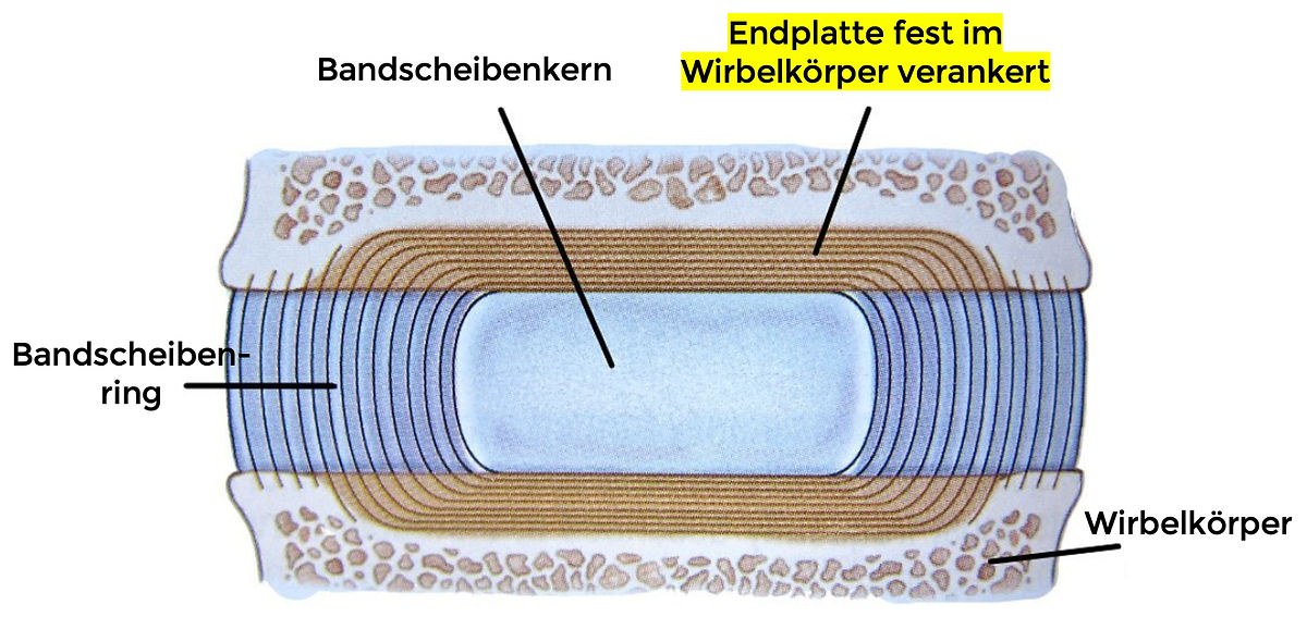 Verankerung der Bandscheibe an der Wirbelendplatte