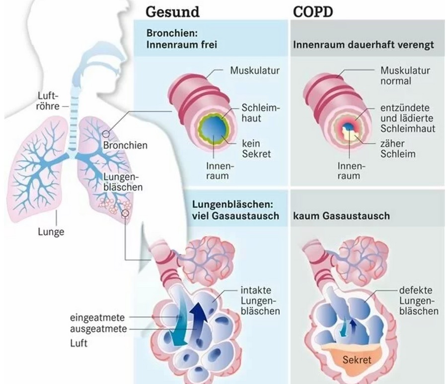Gesunde Lunge vs. COPD