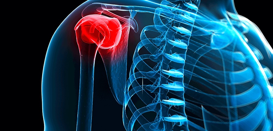 Frozen Shoulder