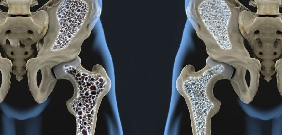 Osteoporose