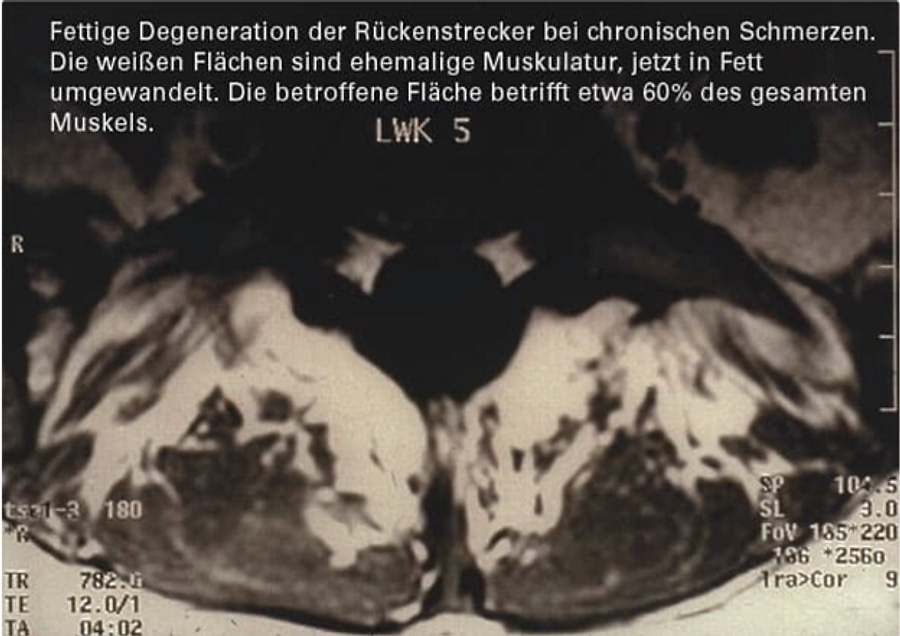 Sarkopenie im Rückenstrecker