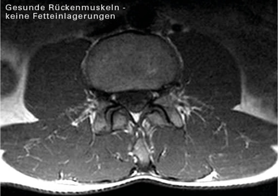 Sarkopenie im Rückenstrecker 2