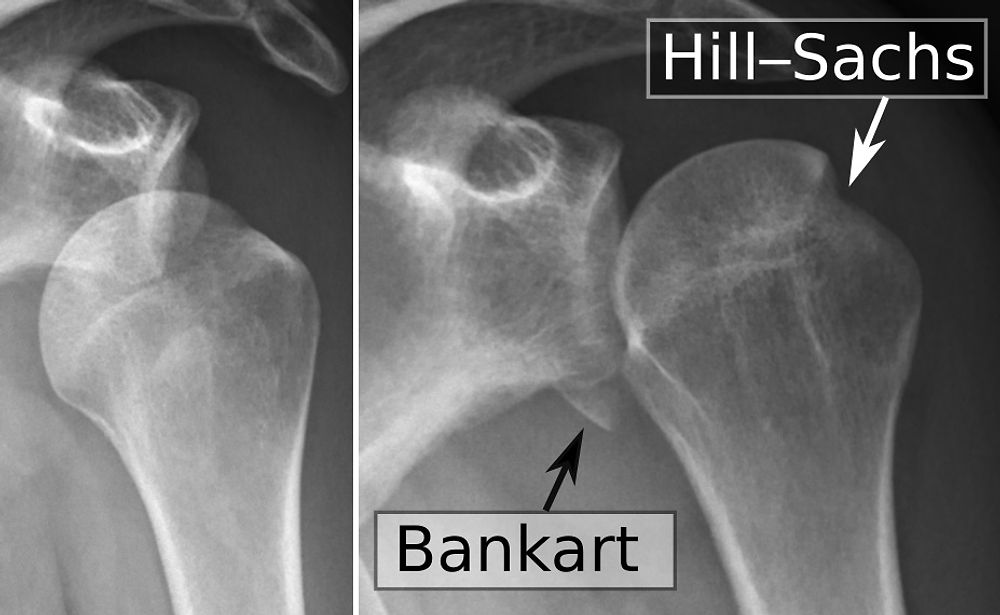 Links eine Auskuglung nach vorne im Röntgenbild. Rechts eine Hill-Sachs-Läsion (Delle im Schulterkopf) und eine Bankart-Läsion (Fraktur am unteren Ende der Schulterpfanne)