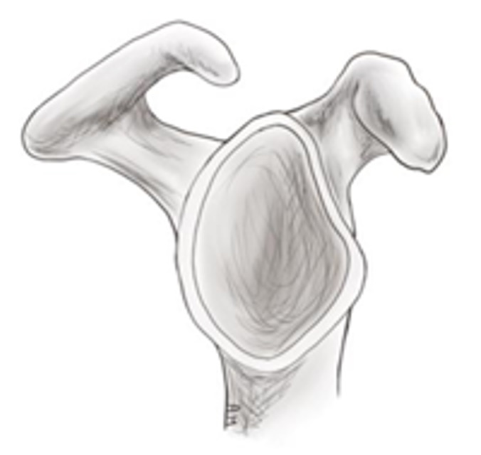 Acromion Typ 3