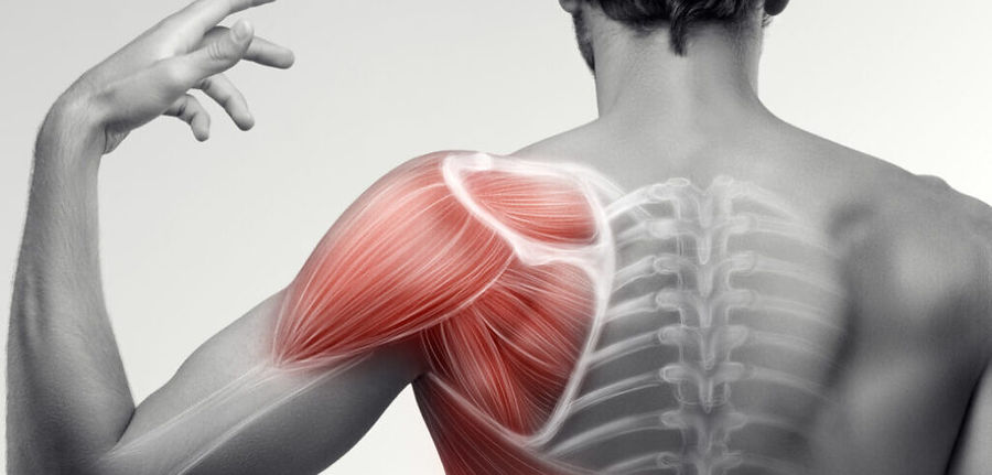 Schulterimpingement